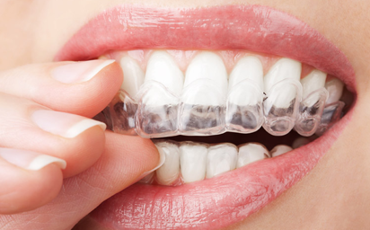 Patient Wearing Invisalign in Honolulu