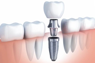 Dental Implants Honolulu, HI